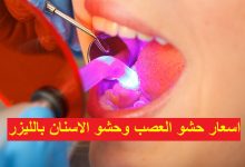 اسعار حشو العصب وحشو الاسنان بالليزر